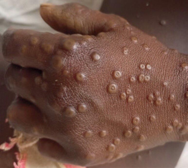 Mpox : Fin de l’urgence continentale, mais maintien de l’alerte nationale en RDC