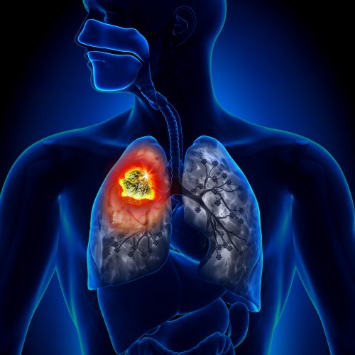 Journée mondiale de lutte contre la tuberculose : un combat toujours d’actualité